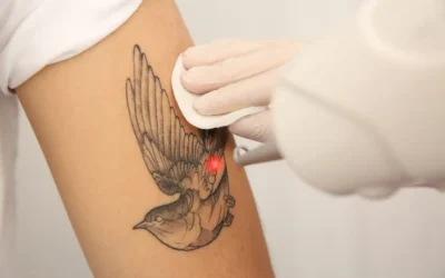 Cover-Up Tattoos vs Laser Removal: Which Is Better?