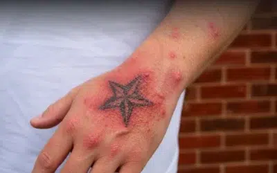 Tattoo Allergic Reactions: Causes, Symptoms and What to Do
