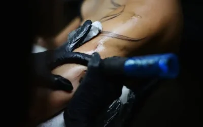 Laser Tattoo Removal Complete Guide: Cost, Sessions and Pain